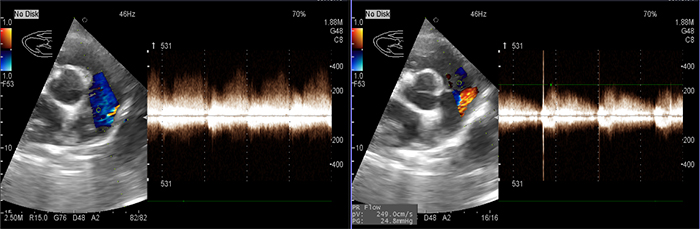 1. In this image of the echocardiogram the blue and red areas show that blood is flowing through a blood vessel that should not be present in a normal dog – the patent ductus arteriosus